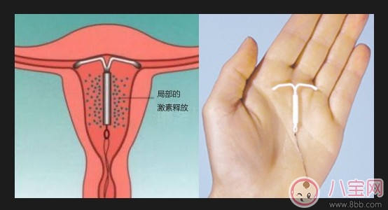 上环后什么时候可进行性生活 女性上环的最佳时期 上环后什么时候可进行性生活 女性上环的最佳时期